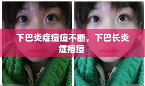 下巴炎症痘痘不断,下巴长炎症痘痘